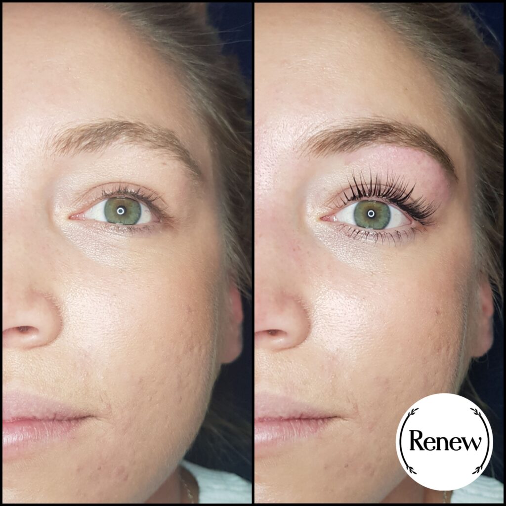 Before and after images showing a lash lift treatment at Renew You.